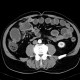 Carcinoid of terminal ileum, mesentery, desmoplastic reaction, prestenotic dilatation: CT - Computed tomography