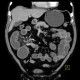 Carcinoid of terminal ileum, mesentery, desmoplastic reaction, prestenotic dilatation: CT - Computed tomography