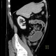 Carcinoid of terminal ileum, mesentery, desmoplastic reaction, prestenotic dilatation: CT - Computed tomography