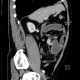 Carcinoid of terminal ileum, mesentery, desmoplastic reaction, prestenotic dilatation: CT - Computed tomography