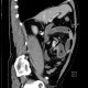 Carcinoid of terminal ileum, mesentery, desmoplastic reaction, prestenotic dilatation: CT - Computed tomography