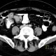 Carcinoid of ileum and mesentery, liver metastasis, CT enterography: CT - Computed tomography