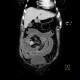 Carcinoid of ileum and mesentery, liver metastasis, CT enterography: CT - Computed tomography