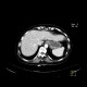 Carcinoid of ileum and mesentery, liver metastasis, CT enterography: CT - Computed tomography