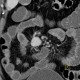 Carcinoid of ileum and mesentery, liver metastasis, CT enterography: CT - Computed tomography