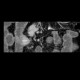 Carcinoid of ileum and mesentery, liver metastasis, CT enterography: CT - Computed tomography