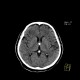 Colloid cyst of the third ventricle: CT - Computed tomography