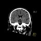 Colloid cyst of the third ventricle: CT - Computed tomography