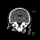 Colloid cyst of the third ventricle: CT - Computed tomography