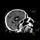 Colloid cyst of the third ventricle: CT - Computed tomography