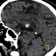 Colloid cyst of the third ventricle: CT - Computed tomography