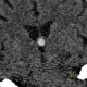 Colloid cyst of the third ventricle: CT - Computed tomography