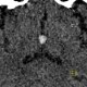 Colloid cyst of the third ventricle: CT - Computed tomography