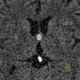 Colloid cyst of the third ventricle: CT - Computed tomography