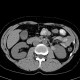 Renal cyst, complicated cyst: CT - Computed tomography