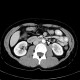 Renal cyst, complicated cyst: CT - Computed tomography