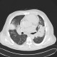 Inflammatory infiltrate of lung, pneumonia: CT - Computed tomography
