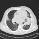 Inflammatory infiltrate of lung, pneumonia: CT - Computed tomography