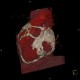 Constrictive pericarditis, VRT: CT - Computed tomography