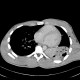 Lung contusion, hemothorax, pneumothorax, chest tube: CT - Computed tomography