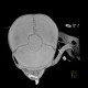 Coronal suture, bone island: CT - Computed tomography