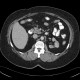 Cortical scars of kidney: CT - Computed tomography