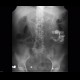 Chronic pancreatitis, calcified, nasojejunal tube: X-ray - Plain radiograph