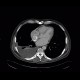 Pericardial calcification, calcified pericarditis, pericarditis calcarea: CT - Computed tomography
