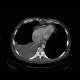 Pericardial calcification, calcified pericarditis, pericarditis calcarea: CT - Computed tomography