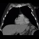 Pericardial calcification, calcified pericarditis, pericarditis calcarea: CT - Computed tomography