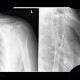 Calcified axillary lymph nodes: X-ray - Plain radiograph