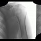 Calcified axillary lymph nodes: X-ray - Plain radiograph