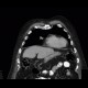 Carcinoid of the lung: CT - Computed tomography