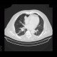 Carcinoid of the lung: CT - Computed tomography