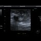 Breast carcinoma: US - Ultrasound