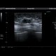Breast carcinoma: US - Ultrasound