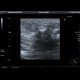 Breast carcinoma: US - Ultrasound