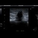 Breast carcinoma: US - Ultrasound