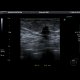 Breast carcinoma: US - Ultrasound