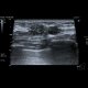 Breast carcinoma: US - Ultrasound