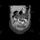 Peritoneal carcinosis: CT - Computed tomography