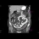 Peritoneal carcinosis: CT - Computed tomography