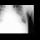 Interstitial edema of the lung, Kerley B lines: X-ray - Plain radiograph