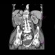 Renal cell carcinoma: CT - Computed tomography