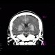 Coagulation necrosis of basal ganglia: CT - Computed tomography