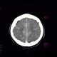 Coagulation necrosis of basal ganglia: CT - Computed tomography