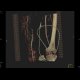 Obliterated right femoral artery and collateralisation, VRT: CT - Computed tomography