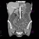 Ileocecal resection, Crohn's disease, CT enterography: CT - Computed tomography