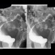 Compression of sigmoid colon: RF - Fluoroscopy