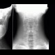 Congenital block of cervical vertebra: X-ray - Plain radiograph